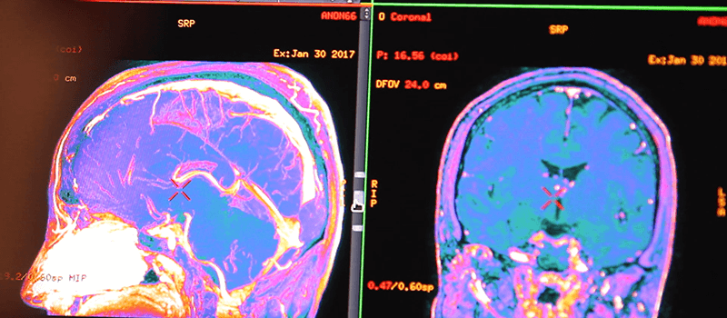 Malattie neurologiche